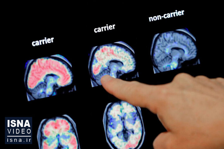 مطالعات جدید متخصصان درباره علت آلزایمر
