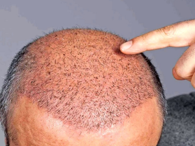 نغمه ای نو در درمان طاسی به گوش می رسد