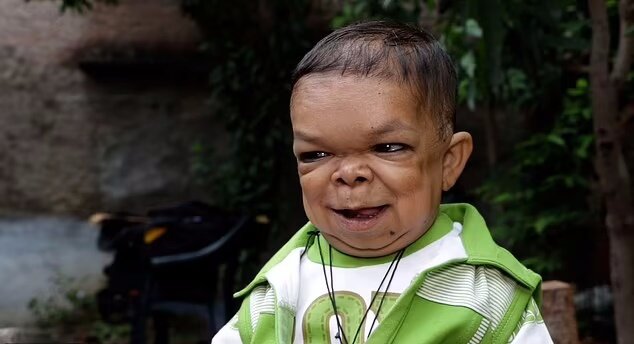 مرد ۶۰ سانتیمتری هندی که از ۵ سالگی دیگر رشد نکرد و تنها ۷ کیلو وزن دارد