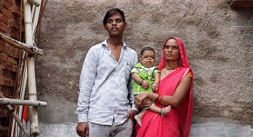 مرد ۶۰ سانتیمتری هندی که از ۵ سالگی دیگر رشد نکرد و تنها ۷ کیلو وزن دارد