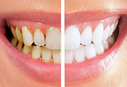 ۱۰ روش‌ جرمگیری دندان در خانه