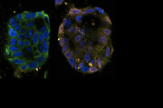 کشف مسیری نوین در مرگ سلول‌های سرطانی / امیدی تازه در درمان سرطان