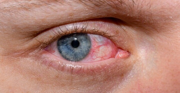 راهنمای پیشگیری و درمان خشکی چشم