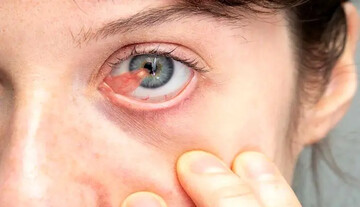 بیماری ناخنک چشم چیست؟ + علائم و درمان خانگی