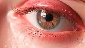 ناخنک چشم چیست؟ درمان خانگی ناخنک چشم