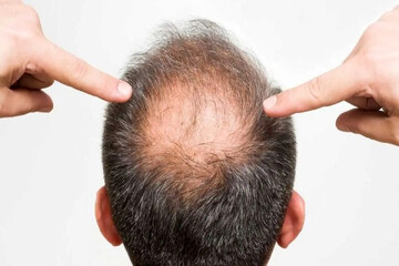 دانشمندان روشی جدید برای جلوگیری از ریزش مو کشف کردند