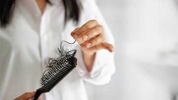 افزایش شدت ریزش مو با مصرف زیاد این ویتامین