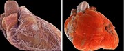 نمایش تفاوت قلب سالم و بیمار در یک عکس