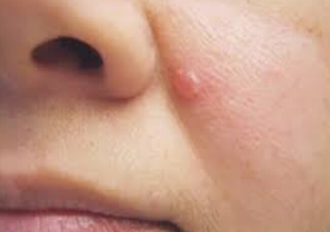 کدام جوشها نشانه سرطان پوست است؟