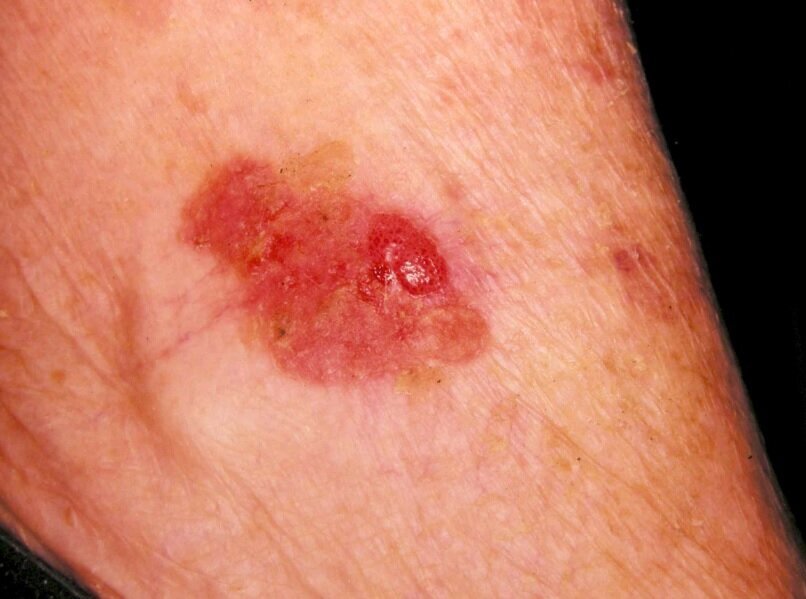 کدام جوشها نشانه سرطان پوست است؟