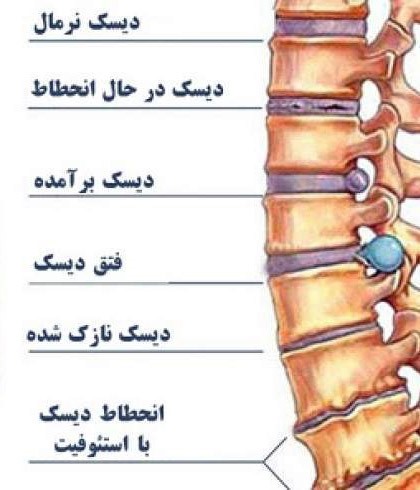 آیا همه دیسکهای بیرون زده ناحیه کمر و گردن دیگر نیاز به جراحی دارند؟