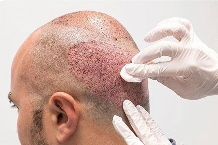 مراقبت های بعد از کاشت مو