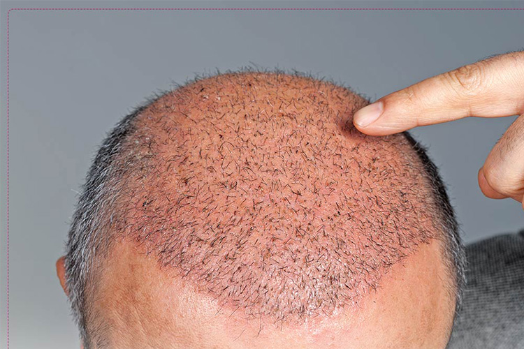 مراقبت های بعد از کاشت مو