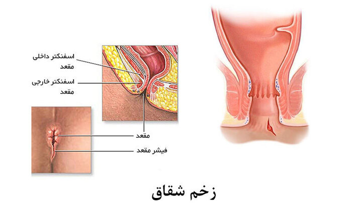 جدول داروهای گیاهی و شیمیایی برای درمان شقاق مقعدی