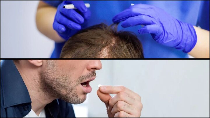 مقایسه کاشت مو با داروهای ضد ریزش مو: کدام یک مؤثرتر است؟