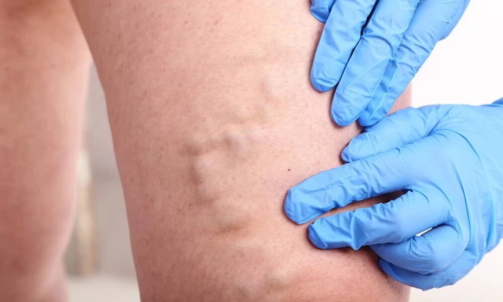 چگونه روغن زیتون میتواند به درمان واریس کمک کند؟