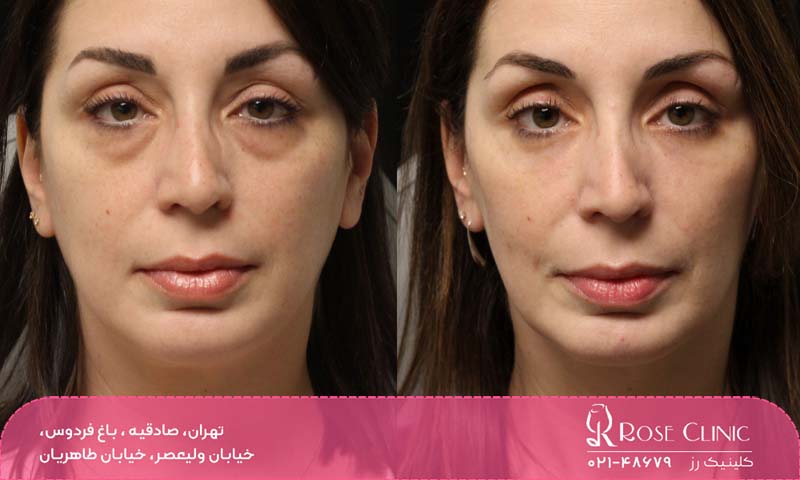 بهترین مرکز بلفاروپلاستی در تهران کجاست؟