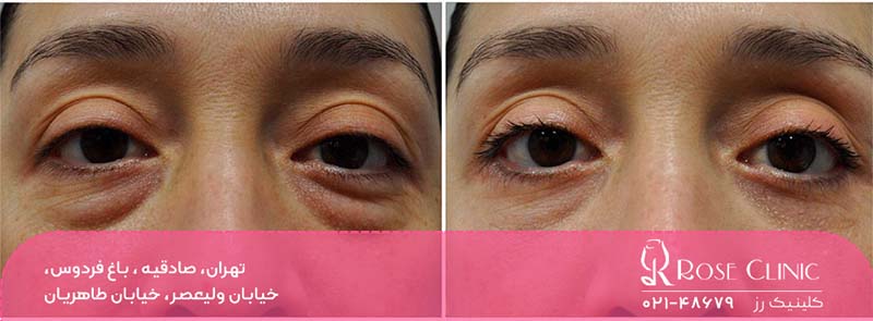 بهترین مرکز بلفاروپلاستی در تهران کجاست؟