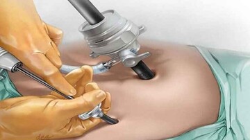 جان باختن زن جوان هنگام جراحی اسلیو معده
