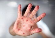 حذف سرخک و سرخجه در ایران توسط سازمان جهانی بهداشت تایید شد