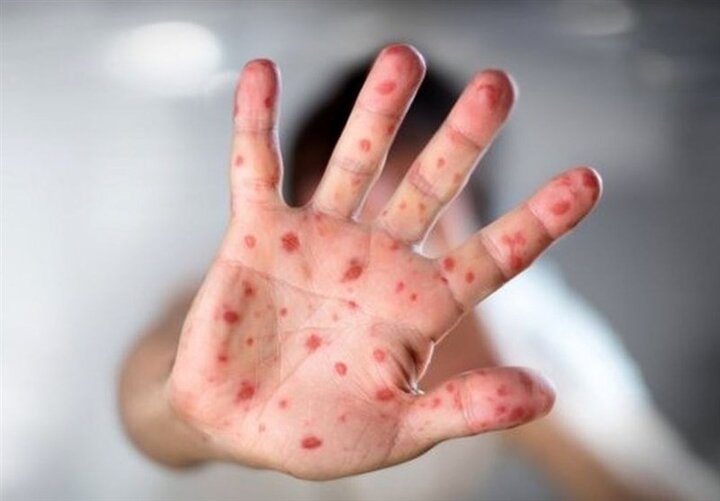 حذف سرخک و سرخجه در ایران توسط سازمان جهانی بهداشت تایید شد
