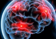 تشخیص زودهنگام آلزایمر با رادیوداروی ایرانی