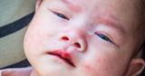 تصاویر دردناک از یک بیماری کشنده در کودکان/ علائم «کاوازاکی» چیست؟