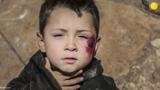 بیماری پوستی سالک  بلای جان کودکان آواره سوری/تصاویر